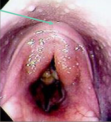 <p>What is this, causing arytenoid chondritis?</p>