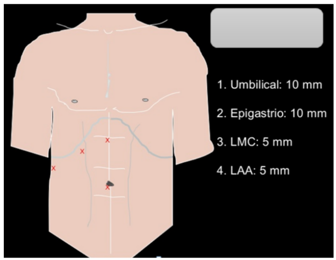 <p style="text-align: justify;"><span style="background-color: transparent;">¿Qué escuela respalda la siguiente técnica quirúrgica laparoscópica?</span></p>