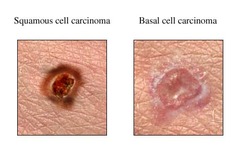 <p>>20 clinicopathologic types</p><p>more common types:</p><p>noduloulcerative </p><p>pigmented</p><p>morpheaform (sclerosing)</p><p>superficial</p>