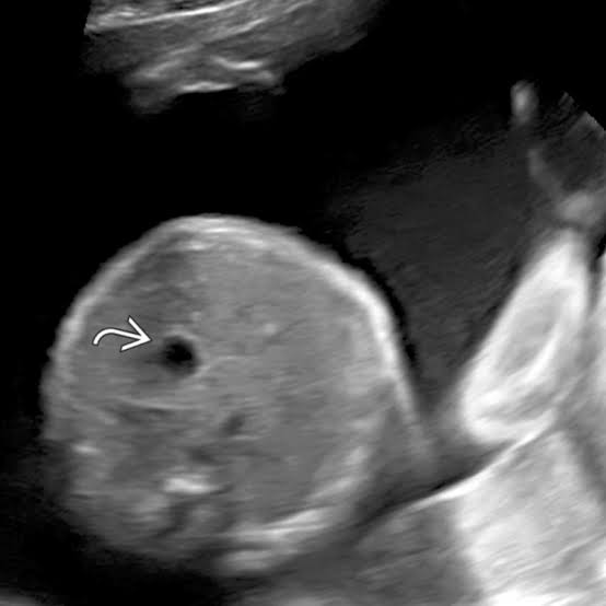 <p>malformation of foregut </p><ul><li><p>associated with tracheoesophageal fistula </p></li><li><p>absent stomach</p></li></ul><p></p>