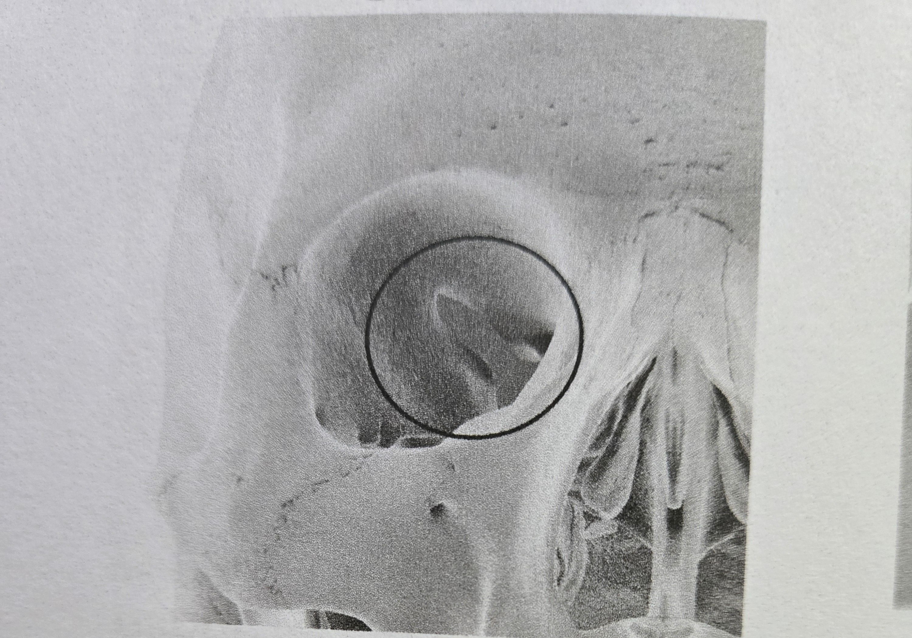 <p>Fissure</p>