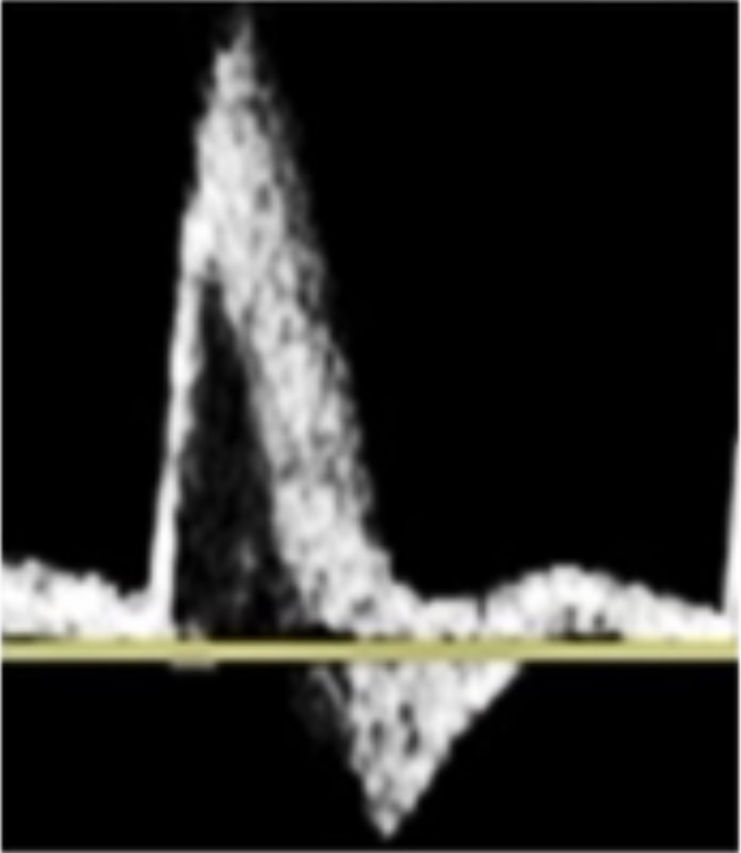<p>This image of the CFA going towards the leg is described as:</p>