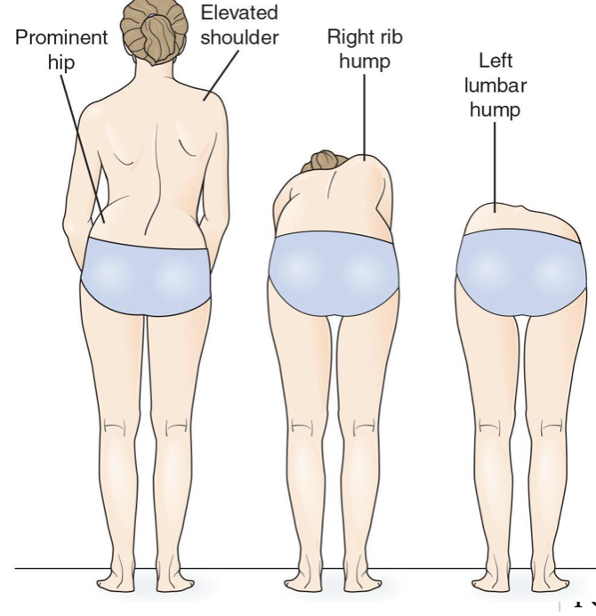 <p>abnormal curvature of the spine in the coronal plane that is typically S-shaped or C-shaped and occurs in three dimensions.</p><ul><li><p>rotation of vertebrae</p></li><li><p>3Dm</p></li><li><p>symmetry of trunk and shoulder </p></li></ul><p></p>
