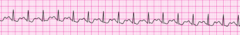 <p>Vagal maneuvers</p>