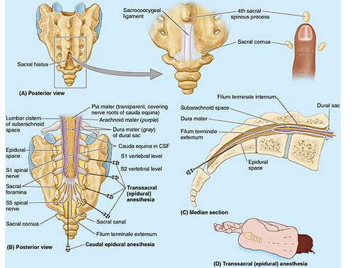 <ul><li><p>U shaped</p></li><li><p>leads into the sacral canal</p></li><li><p>Between sacral cornua, inferior to median sacral crest</p></li><li><p>Provides access to the epidural space</p></li><li><p>Used in OB, pediatric procedure, and chronic pain management</p></li></ul><p></p>