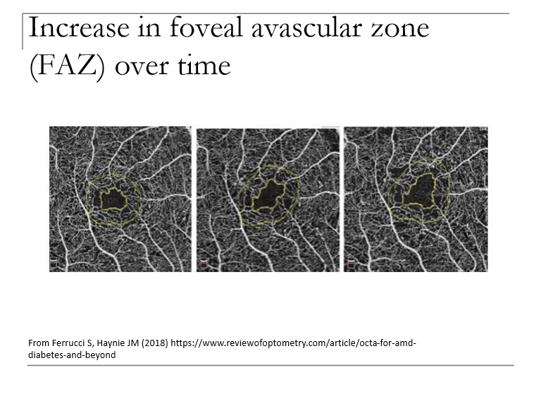 <p>The FAZ enlarges with disease progression.<br>→ Increased FAZ size indicates worsening macular ischemia and capillary rarefaction.</p>