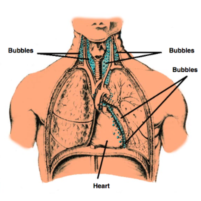 <p><span>lung rupture due to rapid or breath-holding ascent</span></p><ul><li><p><span><strong>Subcutaneous Emphysema:</strong> Characterized by swelling (puffiness) in the face, neck, and chest, along with a "crackling" or "crunching" sensation (crepitus) on palpation.</span></p></li><li><p><span><strong>Mediastinal Emphysema:</strong> Produces chest pain, typically behind the breastbone, which may radiate to the neck, back, or shoulders</span></p></li></ul><p></p>