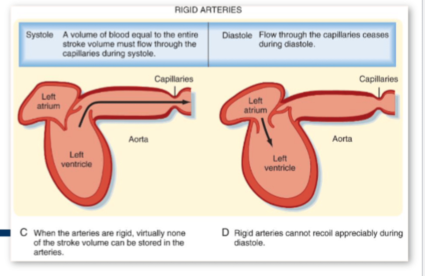 <p>• Systolic pressure >130 with diastolic < 80mmHg</p><p>• Systolic blood pressure (SBP) is the strongest predictor of CV events in adults over 50</p><p>• SBP >>> DBP reflects arterial stiffness, generally caused by aging</p><p>• Stiffness increases the risk of CV morbidity and mortality</p><p>• Takeaway: Could be dangerous since if there is so much stiffness, we are no longer getting rebound during diastole which can lead to static blood &amp; HF</p>