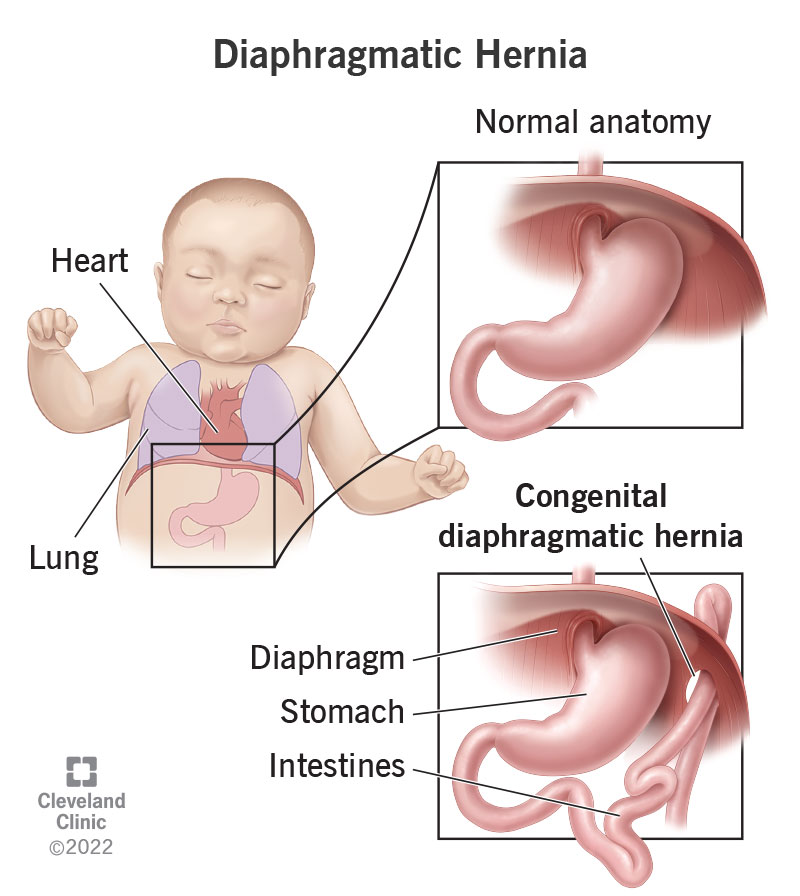 <p>congenital diaphragmatic hernia</p>
