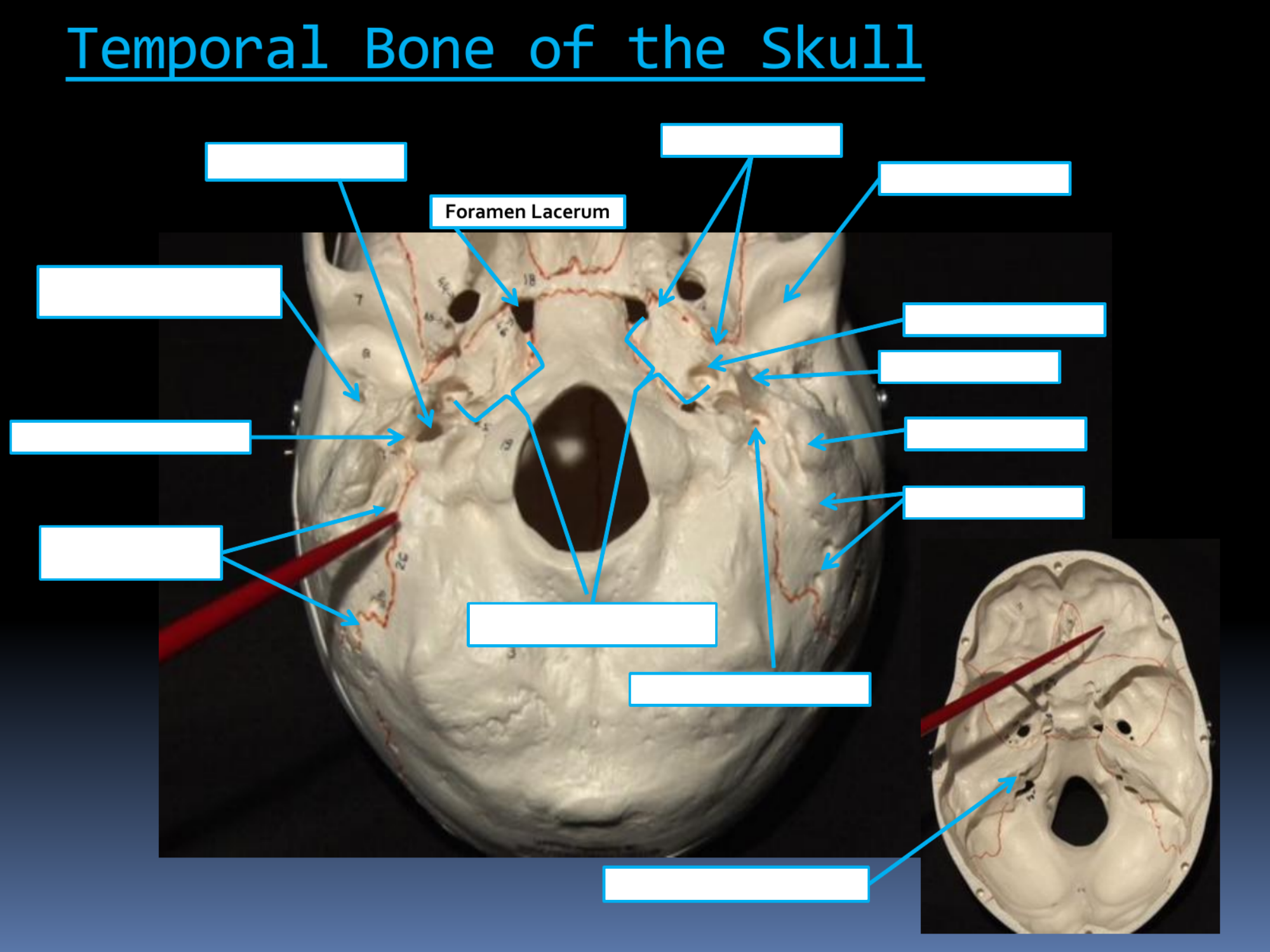 <p>Foramen Lacerum</p>