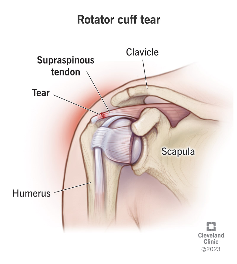 <p><span>What is a rotator cuff tear (RTC tear)?</span></p>