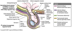 <p>Most common type of hernia</p><p>epidemiology</p><p>-younger males (newborns, children, and young adults)</p><p>occur due to a failure of the processus vaginalis to close during fetal development. (congenital defect).</p><p>Located lateral and superior to the inferior epigastric vessels and protrude through the deep inguinal ring into the inguinal canal into the scrotum.</p><p>Higher risk of incarceration or strangulation</p>