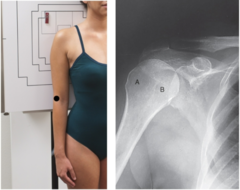 <p>natural arm position without internal or external rotation, proximal humerus in an oblique position (looks like 2 eye balls).</p>
