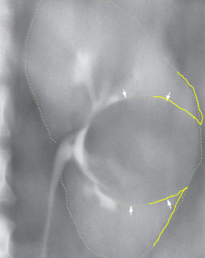 <p>Most common unifocal mass of the kidney; fluid-filled.</p><ul><li><p>“beak sign” on radiograph</p></li></ul><p></p>