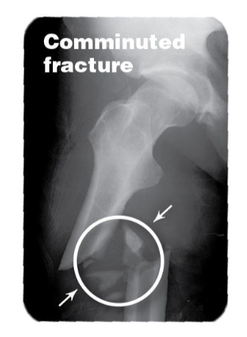<p>shattered bony fragments broken into multiple pieces (3+)</p>