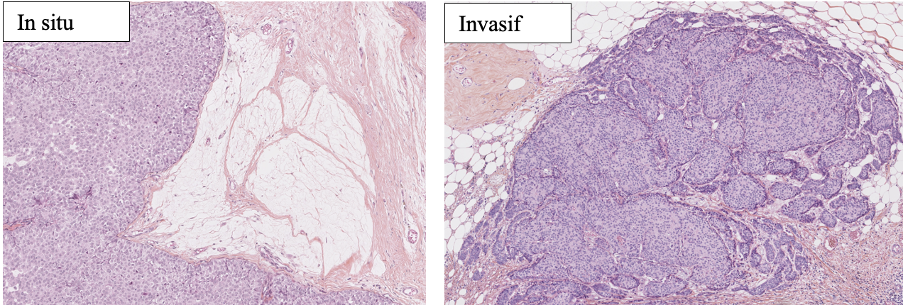 <p>Carcinome papillaire solide </p><p>1) in situ vs invasif</p><p>2) ou sont les cellules myoépithéliales</p><p>3) composante morphologique fréquement associée </p><p>4) IHC</p><p>5) moléculaire</p>