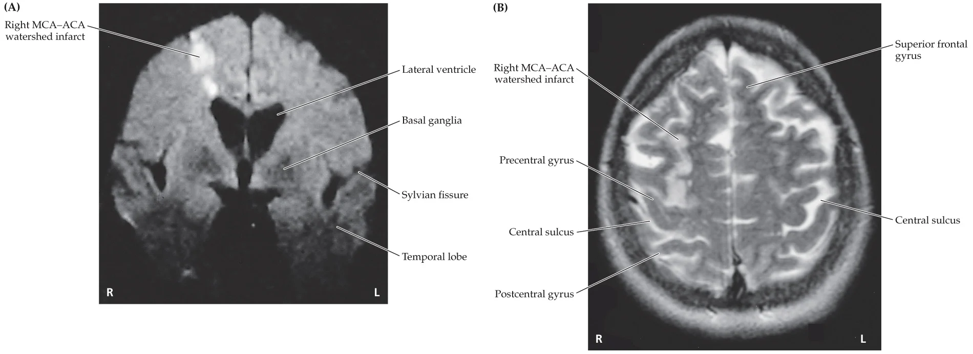<p>watershed infarct ACA-MCA, right motor cortex</p>