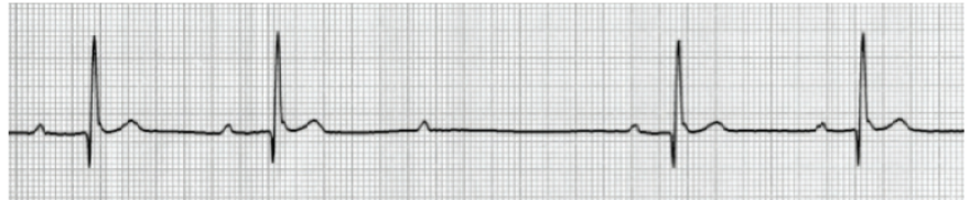 <p>Which degree AV block is this (list the two sub types)? What is featured on this ECG?</p>