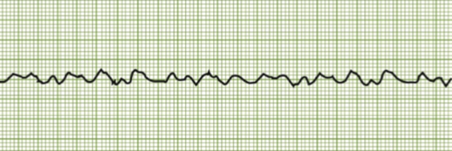 <p>No true forceful contraction but uncoordinated quivering. LIFE THREATENING. Just a scribbly line</p>
