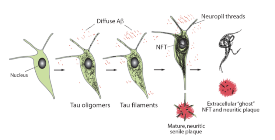 <ul><li><p>Tau changes from <strong>normal → oligomers → filaments → neurofibrillary tangles (NFTs)</strong></p></li><li><p>NFTs accumulate inside neurons → disrupt function</p></li><li><p>Neurons degenerate → release tau → <strong>extracellular “ghost” tangles</strong></p></li><li><p>Associated with <strong>neuritic plaques and neuropil threads</strong></p></li><li><p><strong>Key idea:</strong><br>Tau pathology <strong>progressively damages neurons and spreads</strong>, driving neurodegeneration</p></li></ul><p></p>