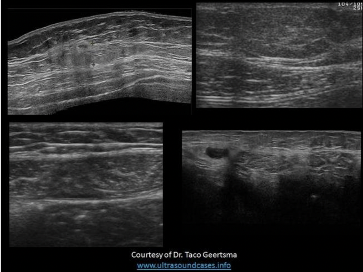 <p>Find the rectus sheath hematoma</p>