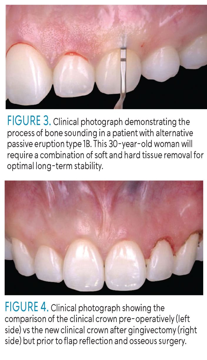 <p><strong><u>attritional wear</u></strong> and changing locations of <strong><u>adjacent and opposing teeth</u></strong></p>
