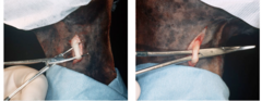 <p>palmar digital neurectomy can be performed ____ or under ___ ___</p>