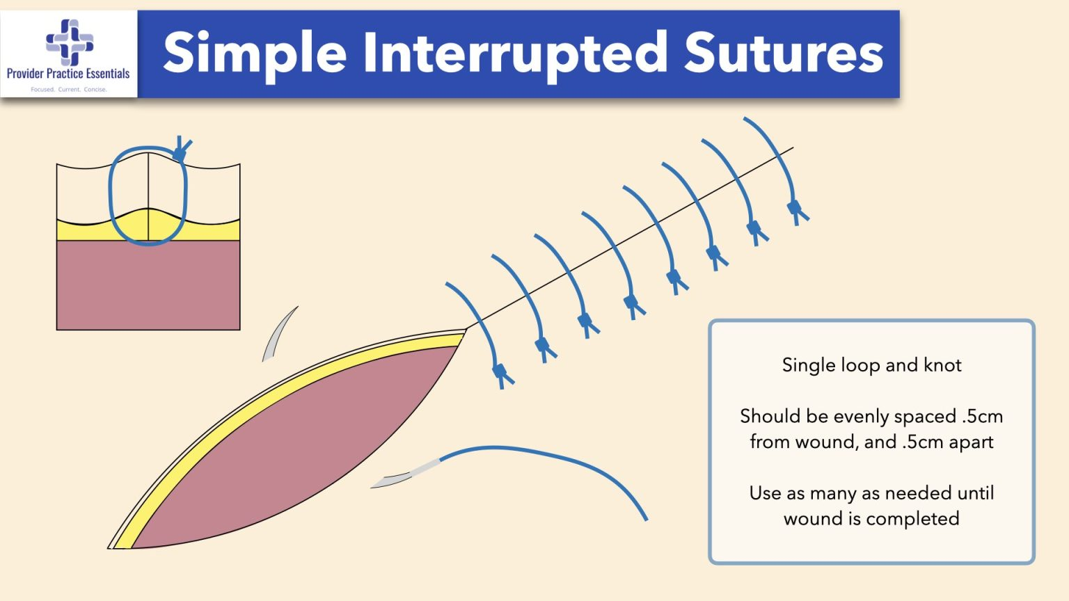<p>Sutures that are individually positioned, tied, and knotted separately.</p><ul><li><p>This method allows for better control over tension and can maintain wound closure even if one stitch fails.</p></li></ul><p></p>