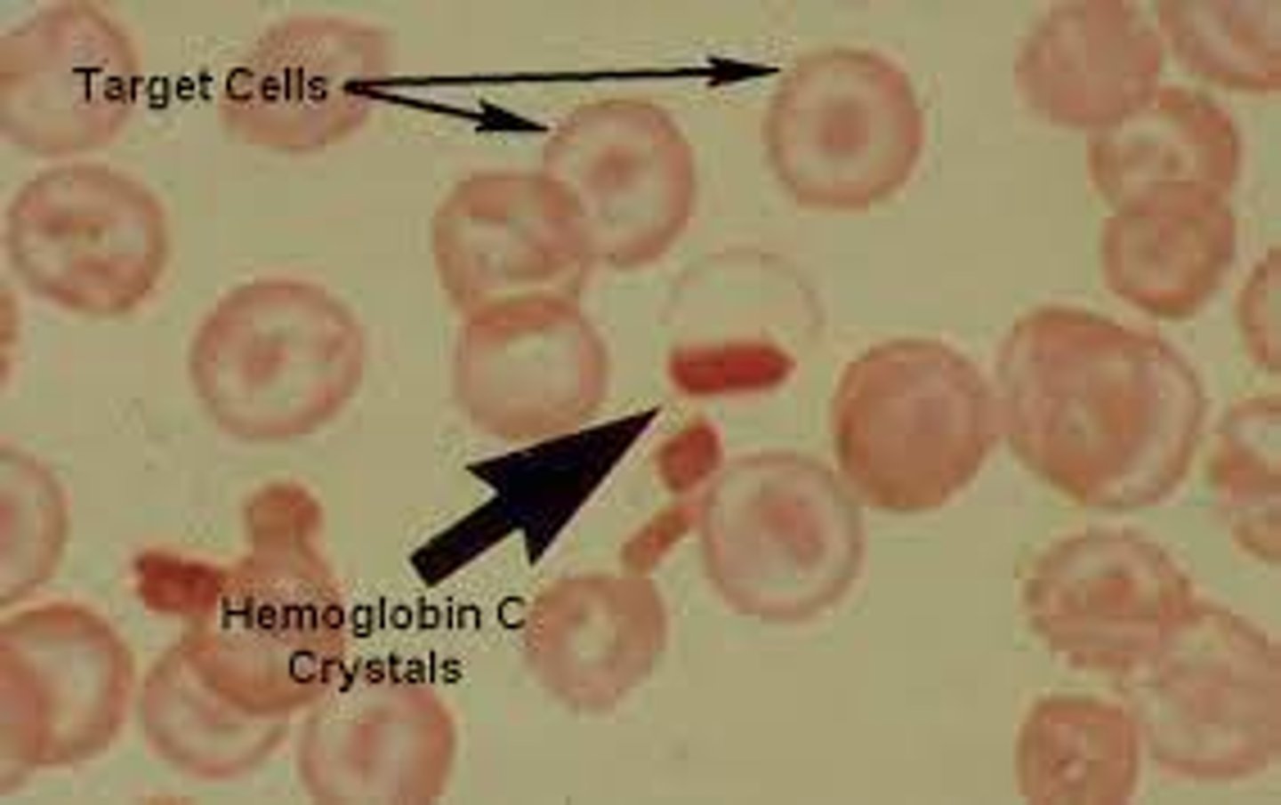 <p>Hgb C disease</p>