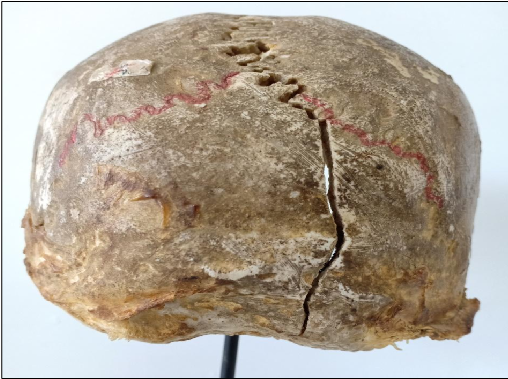 <p>Questions</p><ol><li><p>What is the specimen being examined?</p></li><li><p>What are the types and descriptive features of the fracture shown on the skull?</p></li><li><p>What type of causative instrument and force mechanics produce this injury?</p></li><li><p>How is the time of death estimated?</p></li><li><p>What are the possible causes of death?</p></li><li><p>What is the final diagnosis for this specimen?</p></li></ol><div data-type="horizontalRule"><hr></div><p></p>