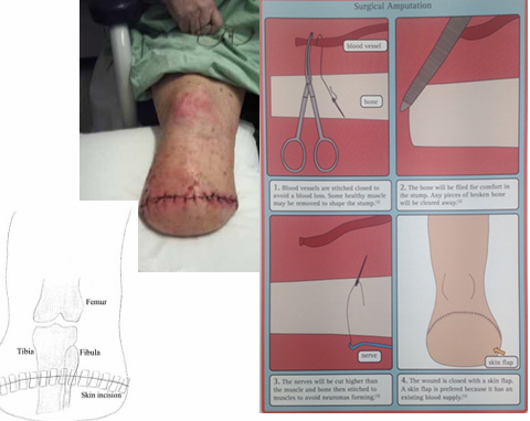 <ul><li><p>Most common = Burgess technique </p></li><li><p>Posterior flap is made from lateral and medial gastrocnemius and some soleus muscle </p></li><li><p>Flap fixed anteriorly by sutures </p></li><li><p>Also referred to as “Below Knee Amputation” (BKA)</p></li></ul><p></p>
