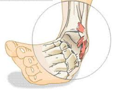 <p>to twist, to sprain</p>