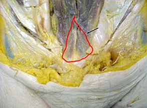 <p>what msucle is highlighted in the image; it lies ANTERIOR to the lower part of the rectus abdominus muscle</p>