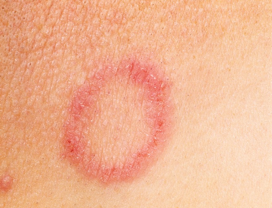 <p>Ringworm (tinea)</p>