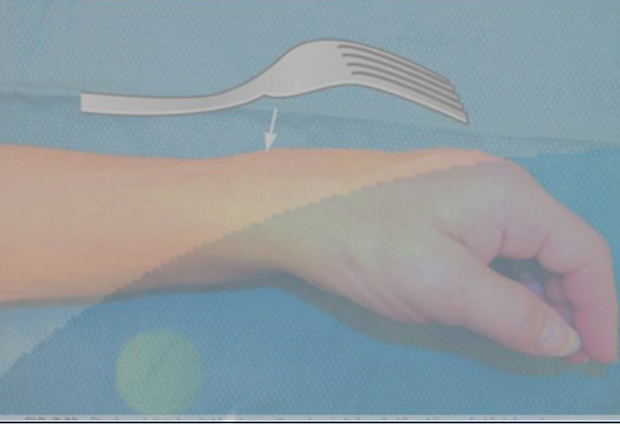 <p>Colles Fracture</p>