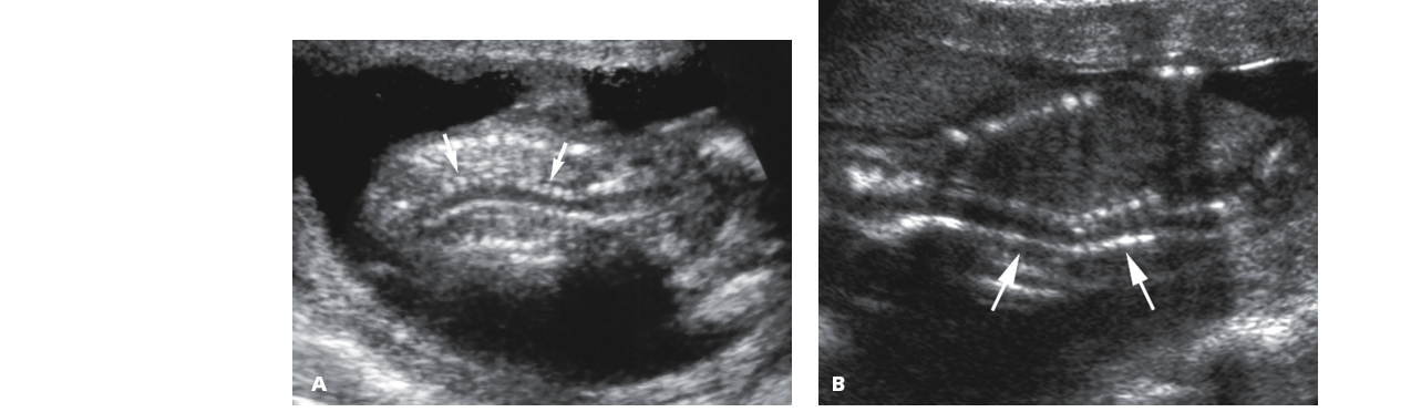 <p>Lateral curvature of the spine</p><p>S-shaped spine</p>