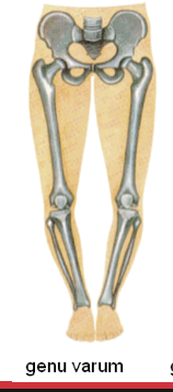 <p>Bowlegs, where the knees remain apart when standing with feet together.</p>