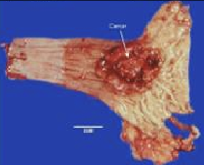 <p>diagnosis, esophageal tumor</p>