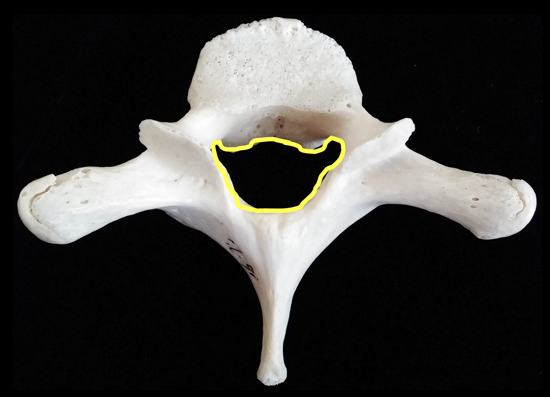 <p>What is the yellow region highlighted on the thoracic vertebrae?</p>