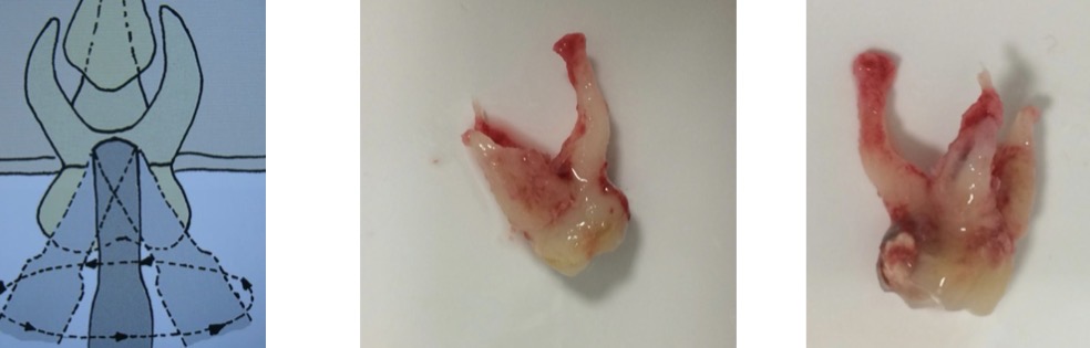 <p>Crown convexity + cervical outline height + root convexity </p><p>Use the elevator to remove insertion</p><p>Start with palatal movements, and after buccal movements</p><p>Soft circular movements can be performed after that</p>