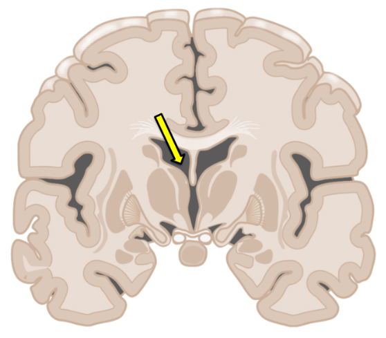 <p>The structure indicated by the arrow is involved in cerebrospinal fluid (CSF) circulation. What is the next immediate step in the process?</p><p>The CSF flows down the cerebral aqueduct</p><p>Additional CSF is produced in the third ventricle</p><p>CSF is resorbed into the dural venous sinuses</p><p>CSF flows through the interventricular foramina</p><p>The CSF flows down to the fourth ventricle</p>