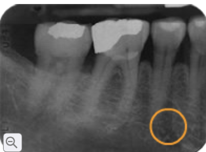 <p>mental foramen</p>
