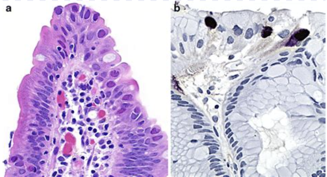 <p>jeune patient avec diarhée </p><p>1) diagnostic</p><p>2) Histologie</p>