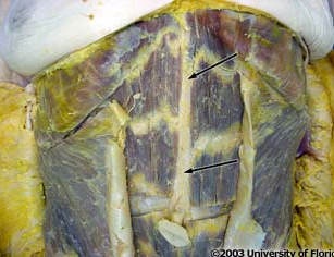 <p>what is the name of the white line that runs vertically from the xiphoid process to the public symphysis called (pictured here)</p>