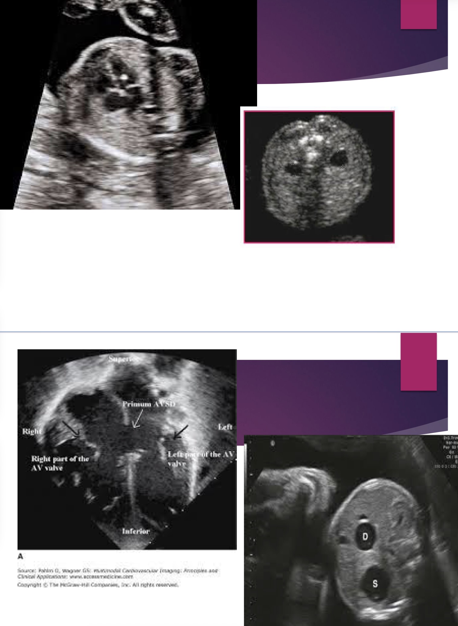 <ol><li><p>Absent / hypoplastic nasal bone</p></li><li><p>Thickened nuchal fold</p></li><li><p>Short femur / humerus</p></li><li><p>Pyelectasis > mild swelling of the renal pelvis</p></li><li><p>Echogenic bowel</p></li><li><p>Echogenic cardiac focus</p></li></ol><p></p>