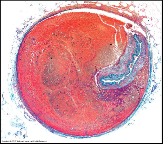 <p>describe Aneurysm</p>
