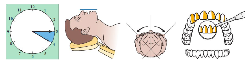 <ul><li><p>Clinician sits 3 to 4 o’clock position</p></li><li><p>Patient chin UP</p></li><li><p>Maxillary occlusal plane perpendicular to floor</p></li><li><p>Patient head: Neutral, left, or right</p></li></ul><p></p>