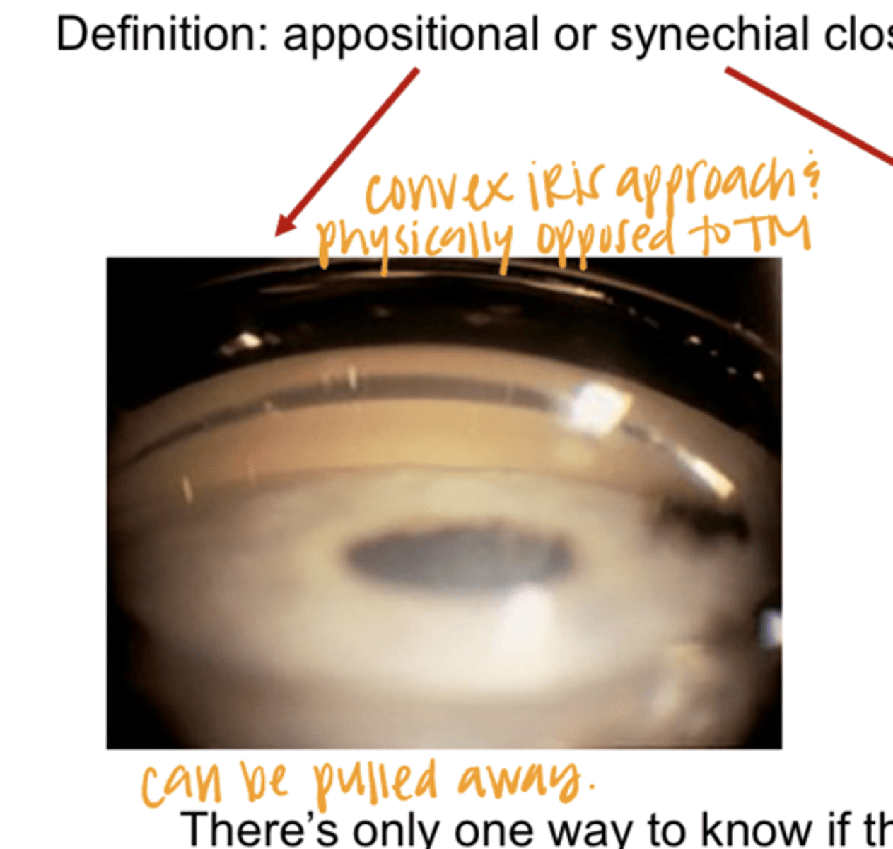 <p>Convex Iris Approach -- Iris Opposed to the TM (Pic)</p>