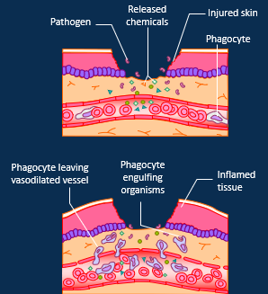<ul><li><p><span>Pathogenic antigens/ cell damage detected</span></p></li></ul><ul><li><p style="text-align: left;"><span>Mast cells release histamine and heparin, causing vasodilation and increased vessel permeability</span></p></li><li><p style="text-align: left;"><span>Clotting factors and complement proteins migrate into interstitial space. Phagocytosis and release of cytokines. Fibrin network forms to trap microbes. </span></p></li><li><p style="text-align: left;"><span>Monocytes attracted to the area – transform into phagocytic macrophages and release proinflammatory cytokines (e.g. IL-1, IL-6 and TNF). Recruitment of lymphocytes</span></p></li><li><p style="text-align: left;"><span>Fibroblasts secrete collagen to form a supportive scar as tissue heals and remodels.</span></p></li></ul><p></p>