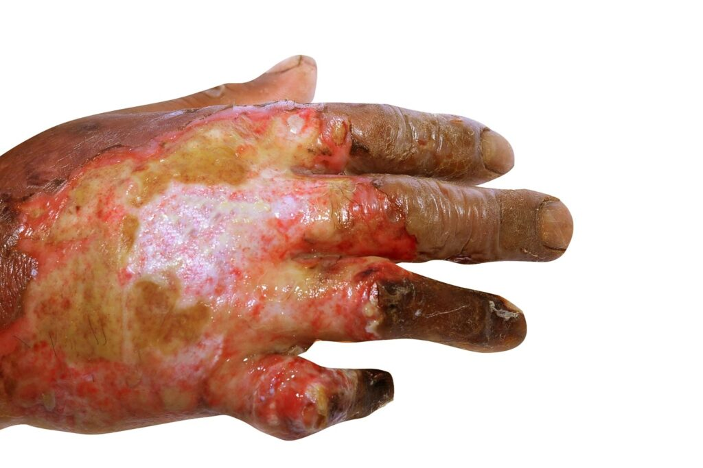 <ol><li><p><span style="color: rgb(194, 36, 216);"><strong>white/pale </strong></span>tissue</p></li><li><p><span style="color: rgb(45, 167, 42);"><strong>huge blisters</strong></span></p></li><li><p><span style="color: rgb(77, 77, 209);"><strong>pale dermis</strong></span> visible</p></li><li><p>heals w/in <span style="color: rgb(241, 106, 106);"><strong>3-9 weeks</strong></span></p></li><li><p><span style="color: rgb(59, 208, 223);">may need <strong>excisions and grafts</strong></span></p></li></ol><p>*deep partial thickness</p>